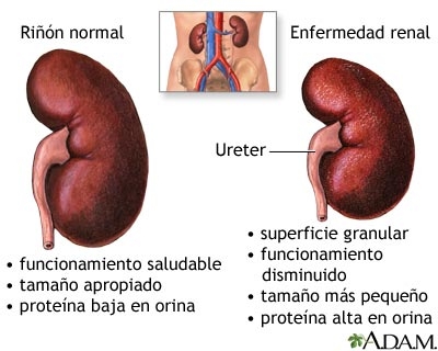 imagine cu nefropatia diabetica